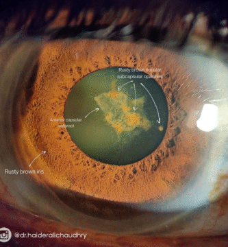 siderosis bulbi