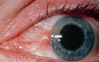 Differential Diagnoses of Conjunctival Masses