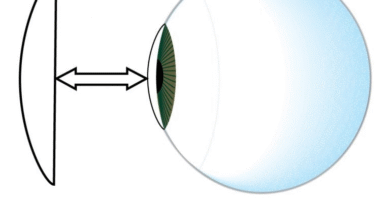Vertex Distance for Contact Lens