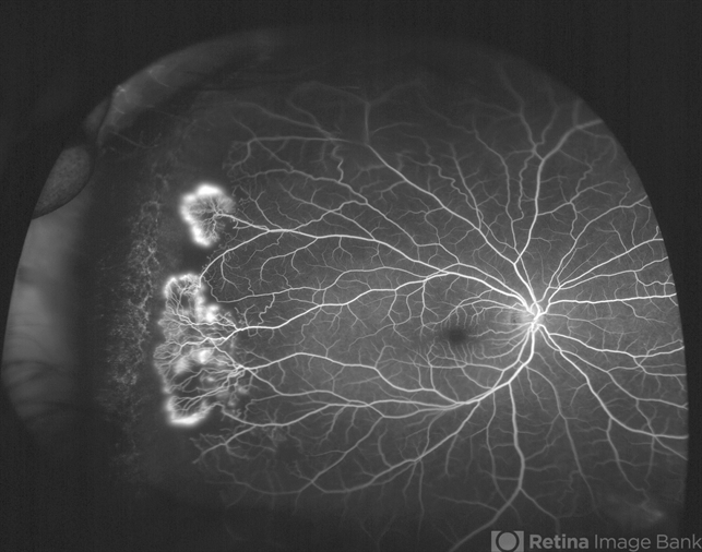 Sickle Cell Retinopathy case