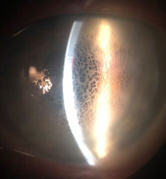 What Is Honeycomb Corneal Edema?
