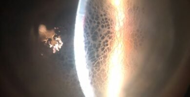 What Is Honeycomb Corneal Edema?