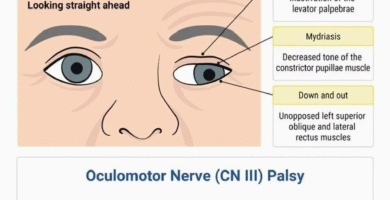 Oculomotor Nerve (CN III) Palsy Notes