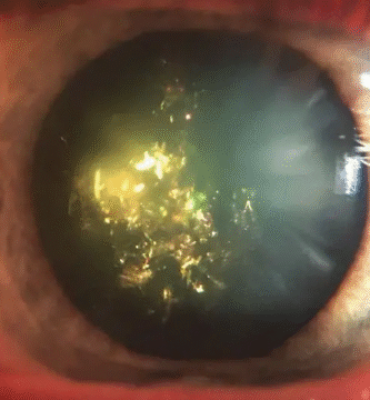 christmas tree cataract