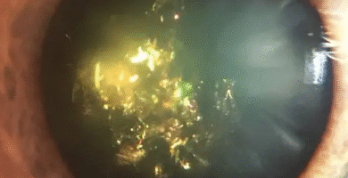 christmas tree cataract