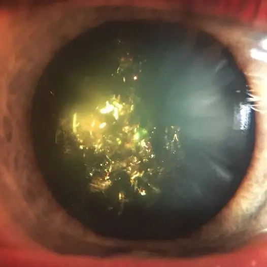 christmas tree cataract