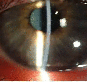 what is punctate keratitis