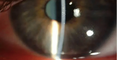 what is punctate keratitis