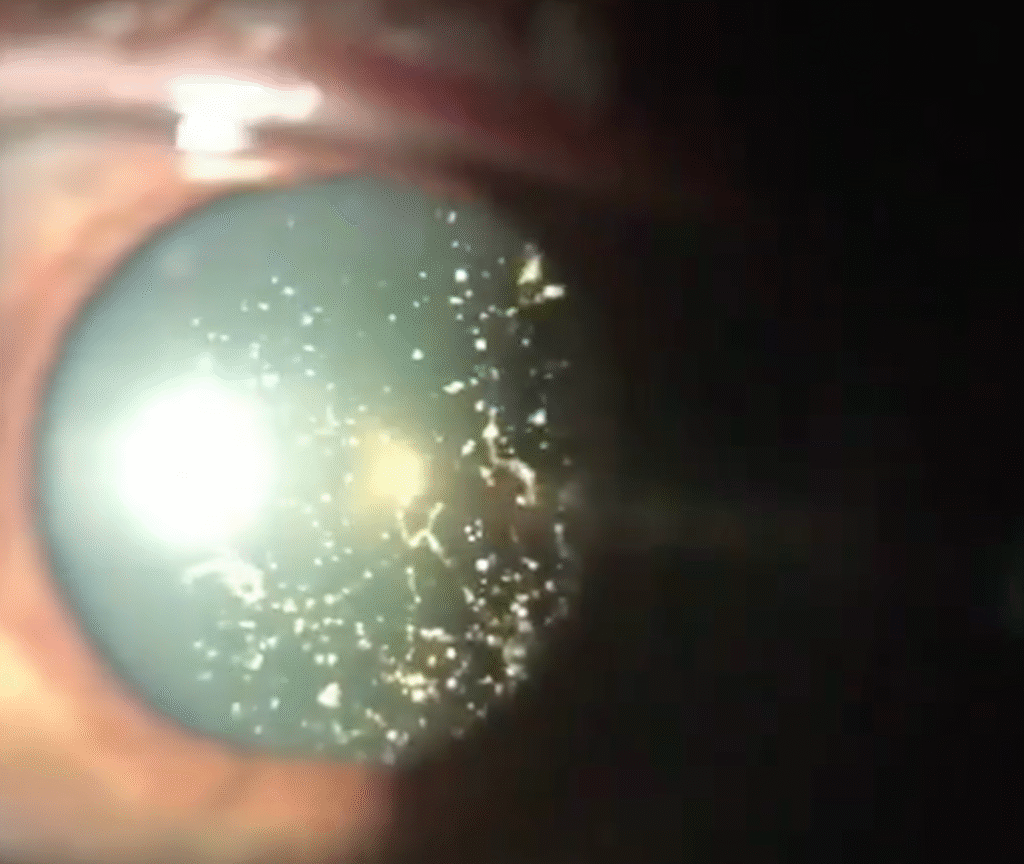 Asteroid Hyalosis in Eye