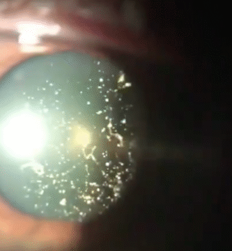 Asteroid Hyalosis in Eye