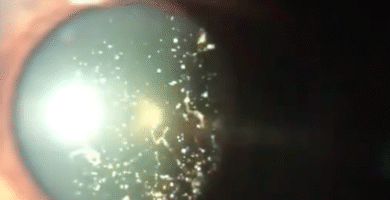 Asteroid Hyalosis in Eye