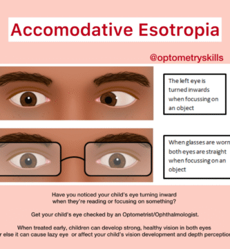 accommodative esotropia