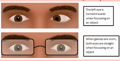 accommodative esotropia