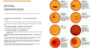 Types of Retinal Hemorrhages and its treatment