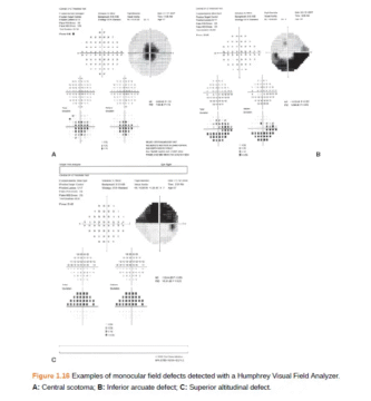 Interpreting Visual Fields