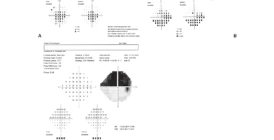 Interpreting Visual Fields