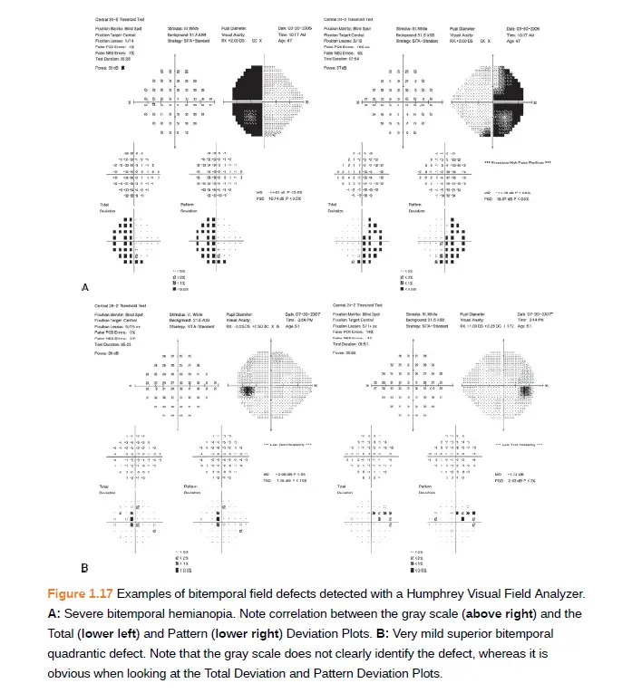 Interpreting Visual Fields
