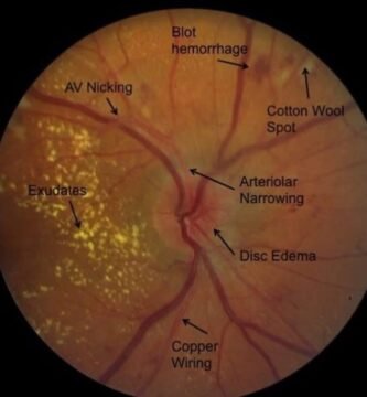 Hypertensive Retinopathy Retinal Findings