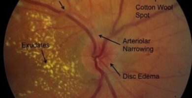 Hypertensive Retinopathy Retinal Findings