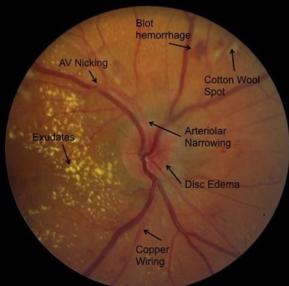Hypertensive Retinopathy Retinal Findings
