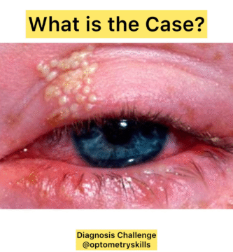 Diagnose this Eyelid Disease