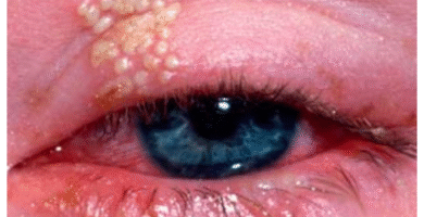 Diagnose this Eyelid Disease