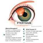 Pterygium Awareness Poster