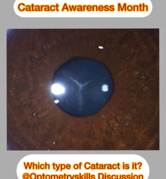 cataract picture quiz