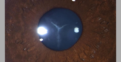 cataract picture quiz