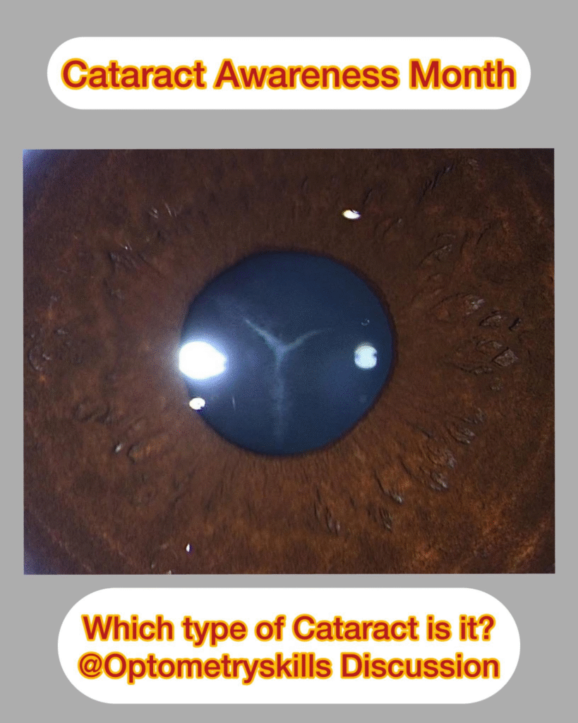 cataract picture quiz