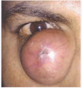 Dacryocystomucopyocele