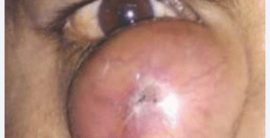 Dacryocystomucopyocele