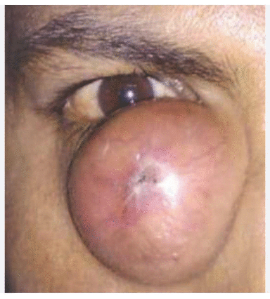 Dacryocystomucopyocele