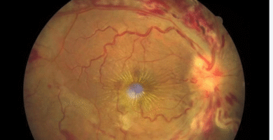 macular star
