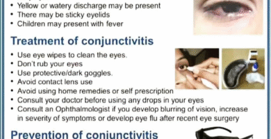 Conjunctivitis- Eye Flu