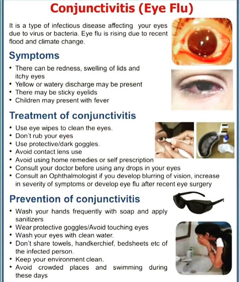 Conjunctivitis- Eye Flu