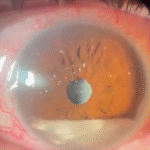 Synchysis Scintillans – The Sparkling Eye Condition