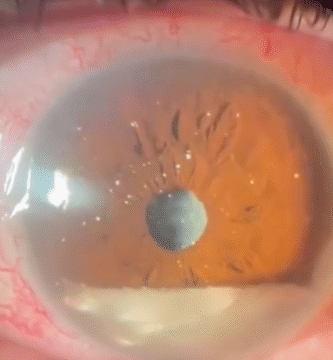 Synchysis Scintillans – The Sparkling Eye Condition