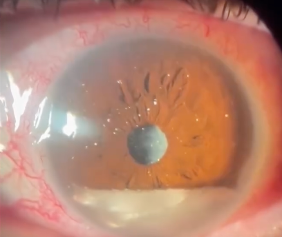 Synchysis Scintillans – The Sparkling Eye Condition