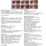 Duane Syndrome Notes