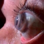 scleral contact lens