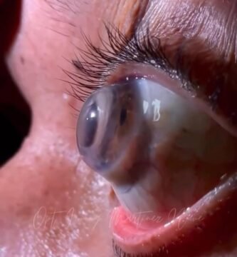 scleral contact lens