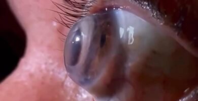 scleral contact lens