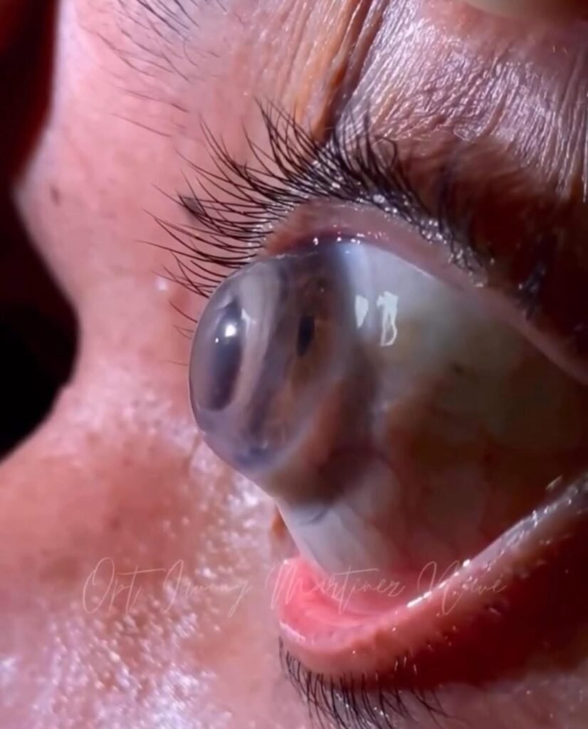 scleral contact lens