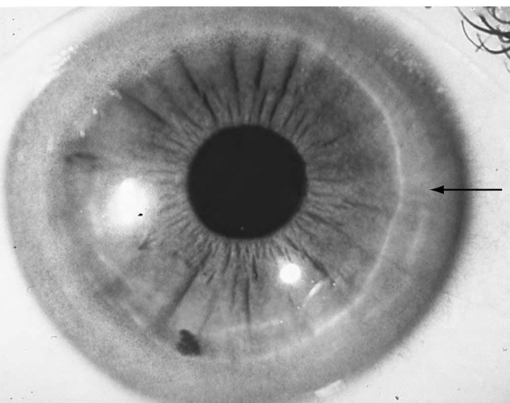 Corneal Pigmentations