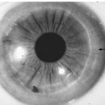 Corneal Pigmentations