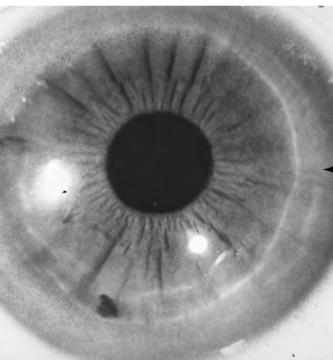 Corneal Pigmentations