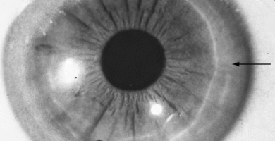 Corneal Pigmentations