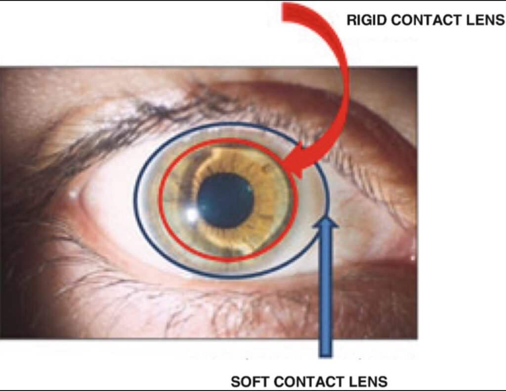 piggybank contact lens