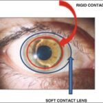 piggybank contact lens